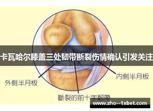 卡瓦哈尔膝盖三处韧带断裂伤情确认引发关注 卡瓦哈尔膝盖三处韧带断裂伤情确认引发关注